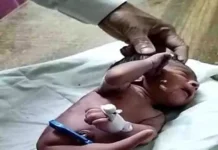 पैदा हुआ अनोखा बच्चा पैर की जगह निकला सींग 1943472 untitled 122 copy